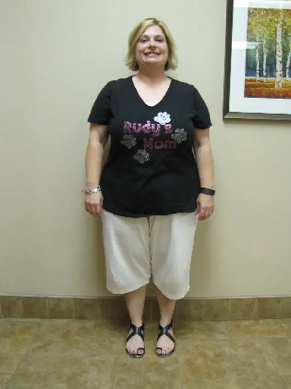 Corinne before bariatric surgery