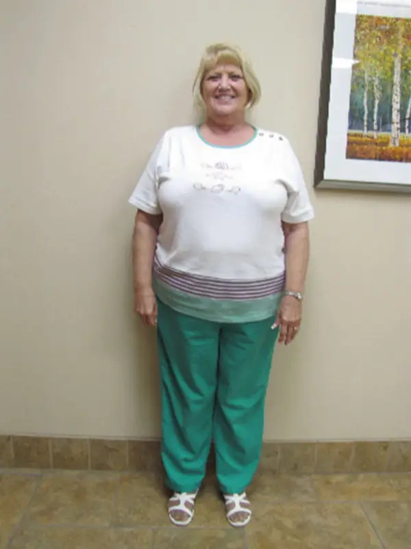 Lenora before bariatric surgery